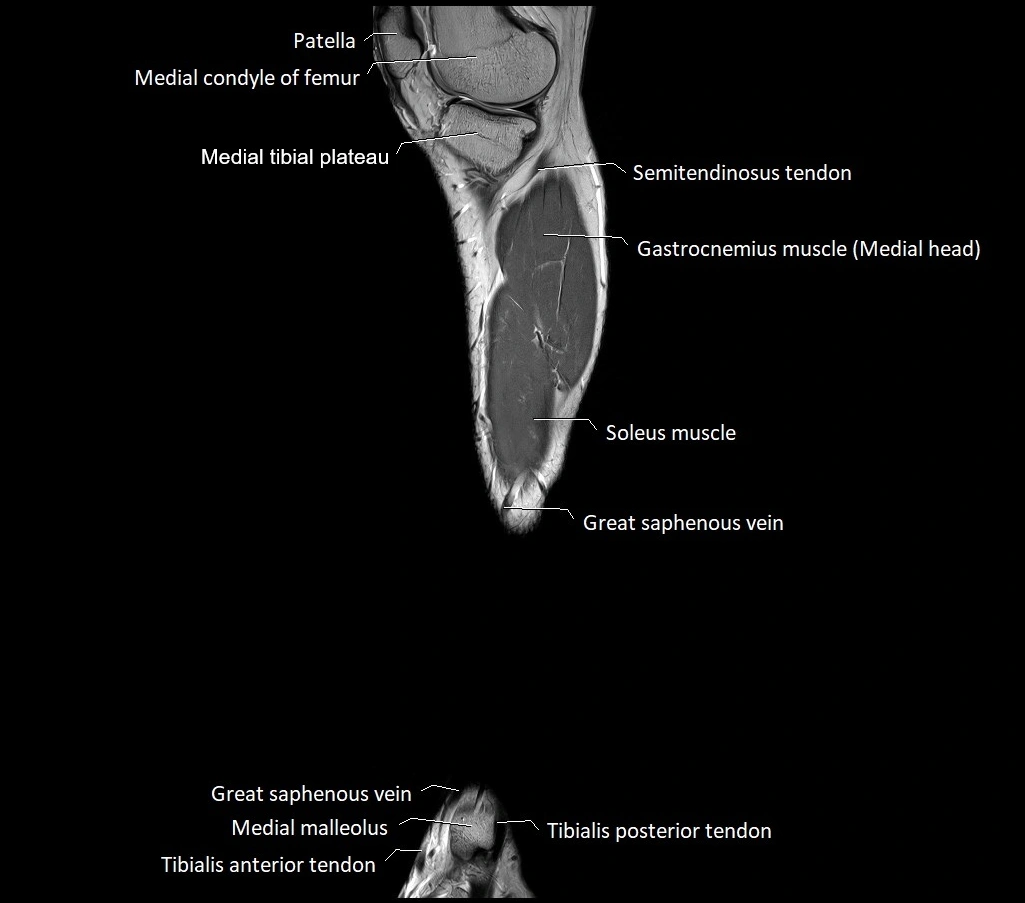 Lower leg sagittal anatomy 3T MRI image 25.webp